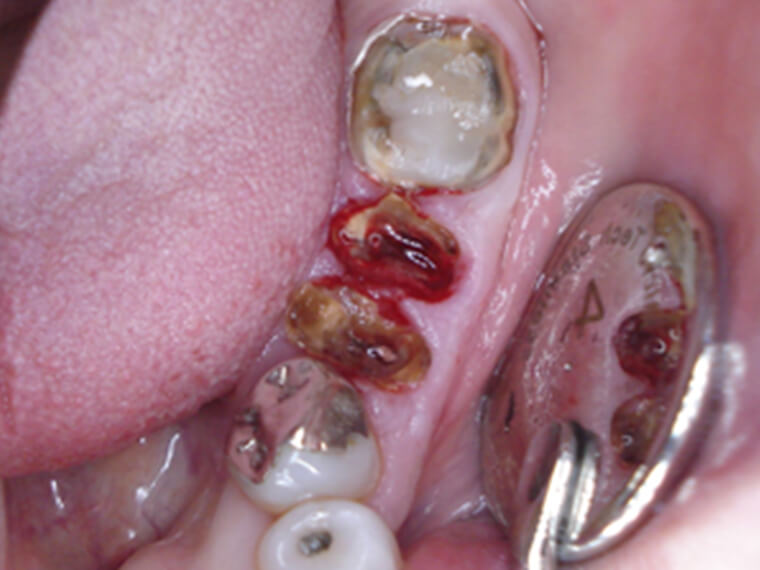 ネオスインプラントを使用した抜歯即時インプラント（宮路 博文先生）