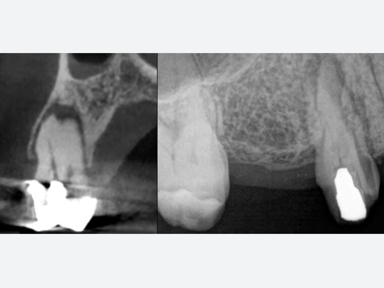 NEOSSインプラントの上顎小臼歯部への応用（山口 文誉先生）