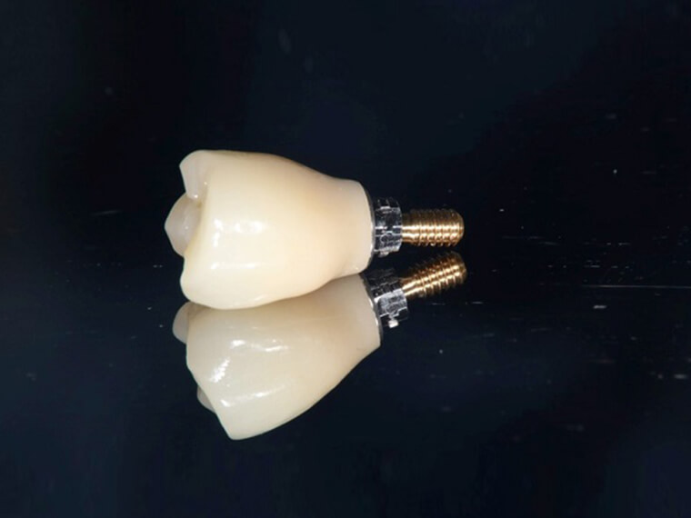 口腔内スキャナーを用いたNeoss Implantの上部構造作製へのデジタルワークフロー（夏堀 礼二先生）