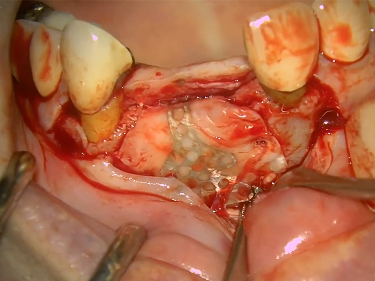 骨造成用非吸収性e-PTFEメンブレン、ネオジェンの臨床動画（中田 光太郎先生）